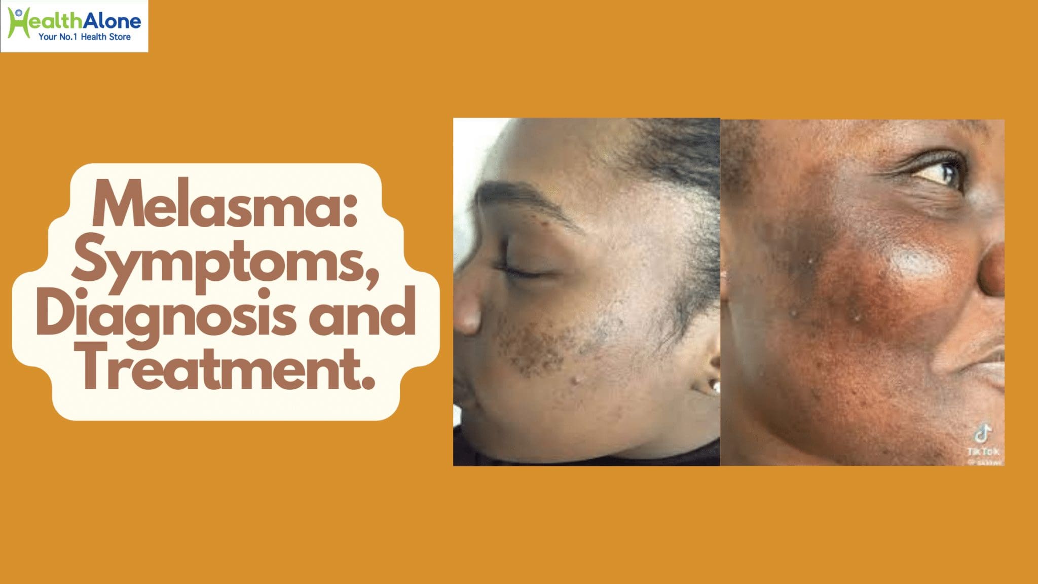 Melasma: Symptoms, Diagnosis and Treatment.