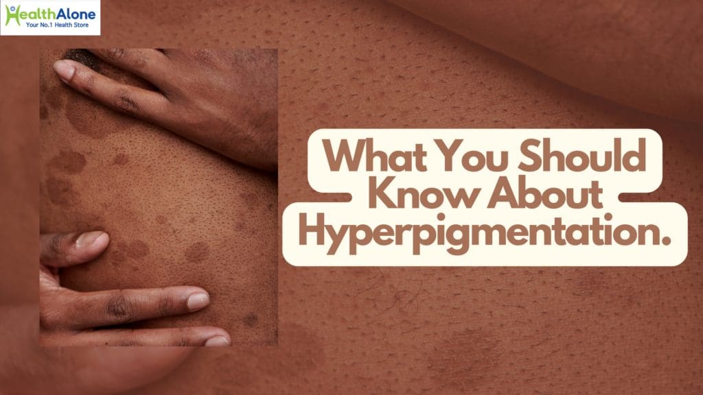 What you need to know about hyperpigmentation