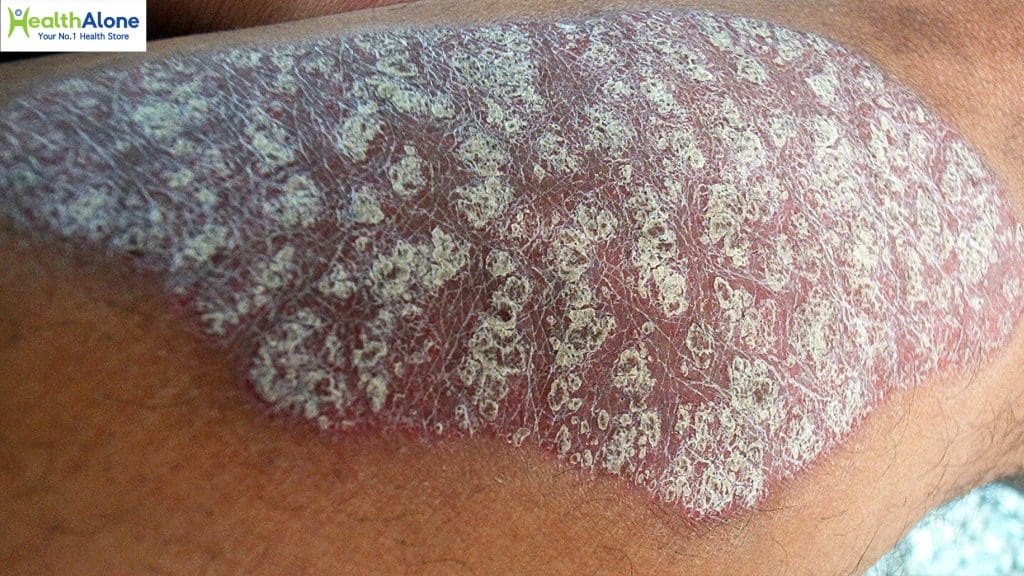 Managing psoriasis with effective tips and treatments for clear skin